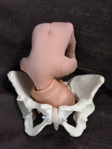 The baby who is asynclitic after engagement is at a disadvantage. Soften and balance then get upright for stronger and more effective surges to bring baby down