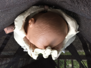 The baby's head is asynclitic. On one side there is more head coming down, and less cervix. On the other side there is more cervix but less head. I'm not talking front to back, but rather, side-to-side.
