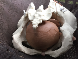 Now baby is synclitic and about to rotate on the pelvic floor (not shown)