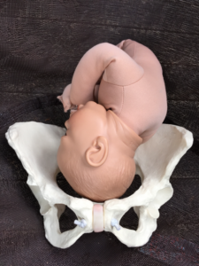 Normal posterior asynclitism - this just means baby's head now tips below the sacral promontory