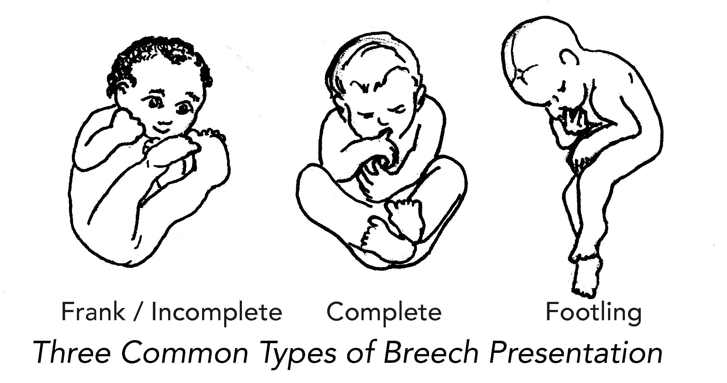 types of breech presentation