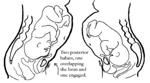 Posterior - A Guide to Posterior Fetal Presentation - Spinning Babies