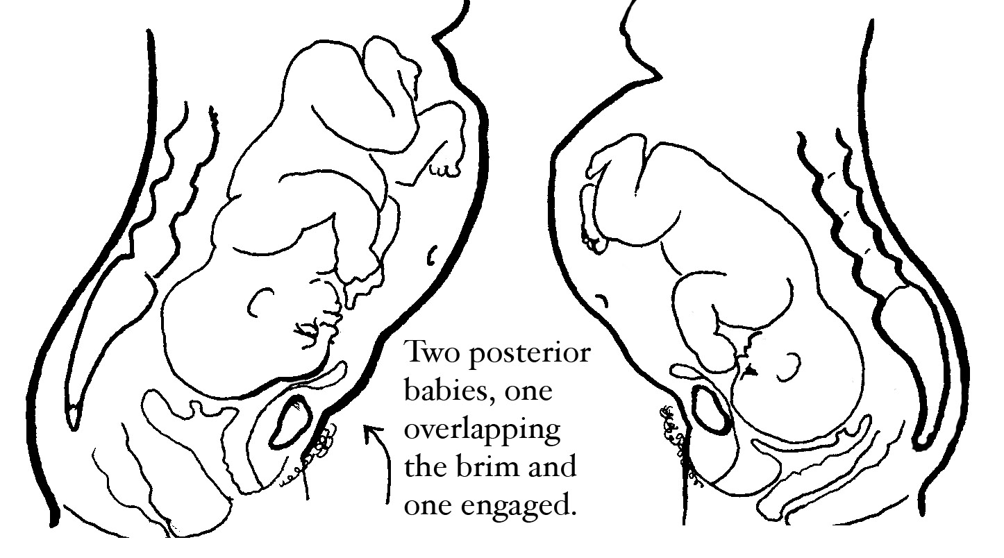 Two posterior babies, one baby will fit and one baby won't fit