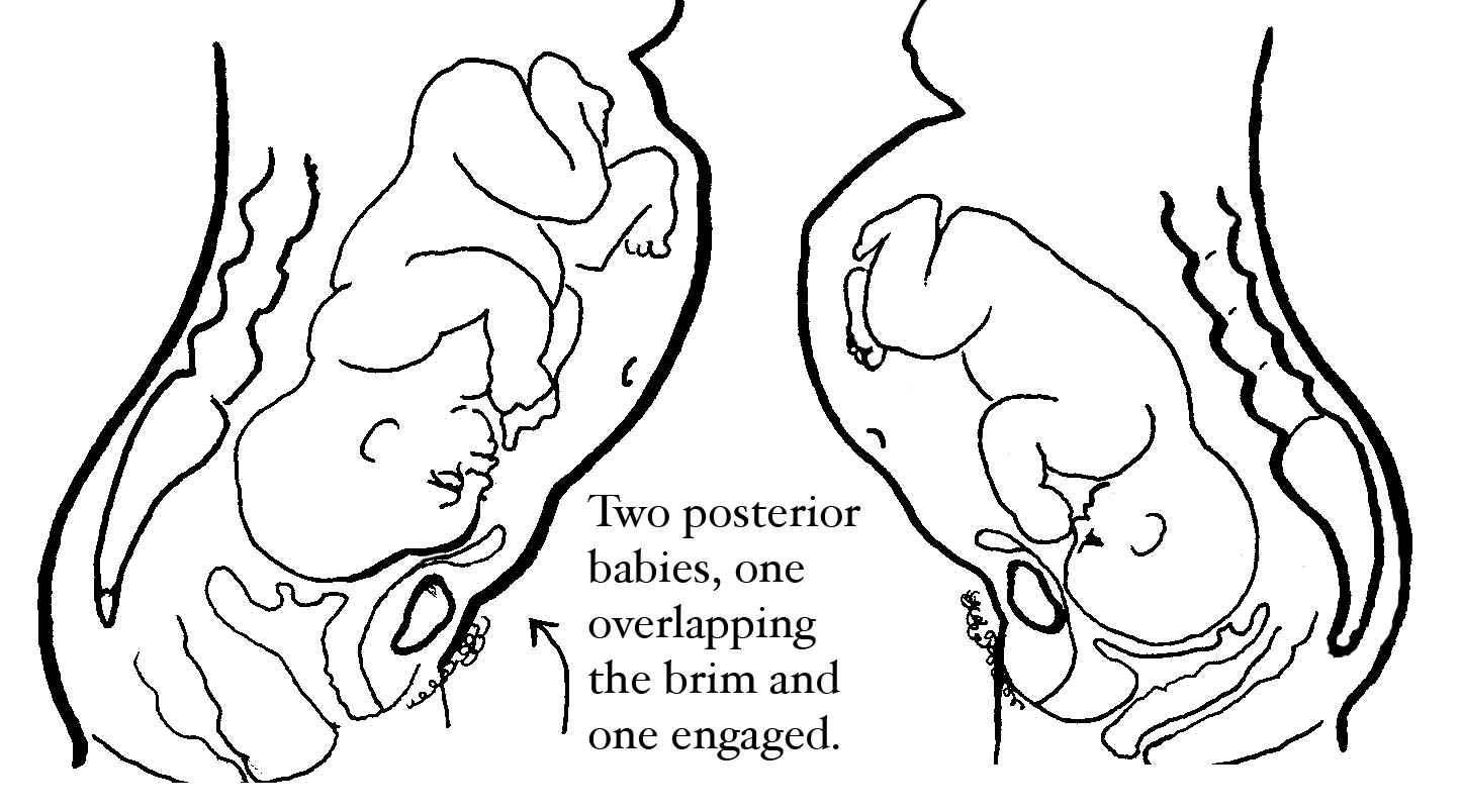 Fetal Head Engagement Chart