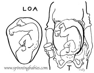 Spinning babies. Intrauterine position being left occiput anterior.