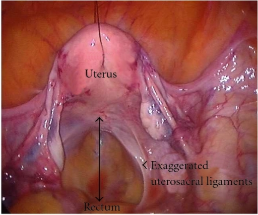 Photo of uterus with ligaments 