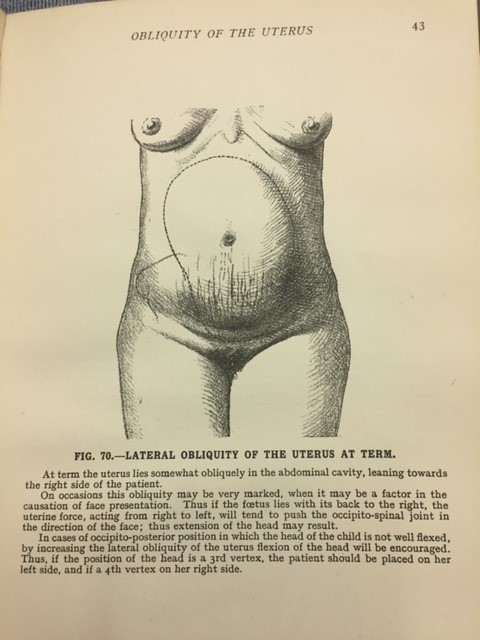Obliquity of the Uterus Illustration: Pictorial Midwifery 1948, Berkeley