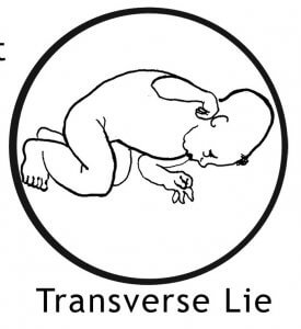 transverse face down baby